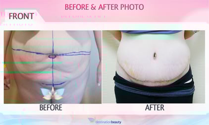 Sharon�s tummy tuck surgery with Dr. Angkana in Bangkok!